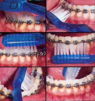 Brushing with Braces